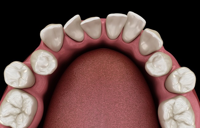 Illustration of gapped teeth