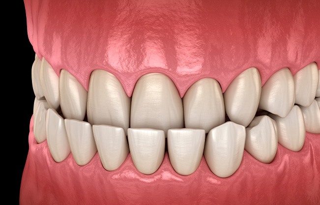 Illustration of an underbite