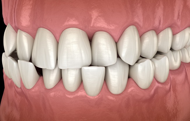 Illustration of a crossbite