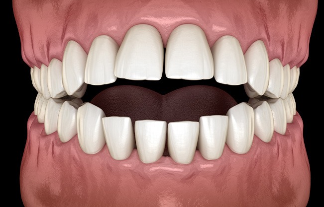 Illustration of an open bite