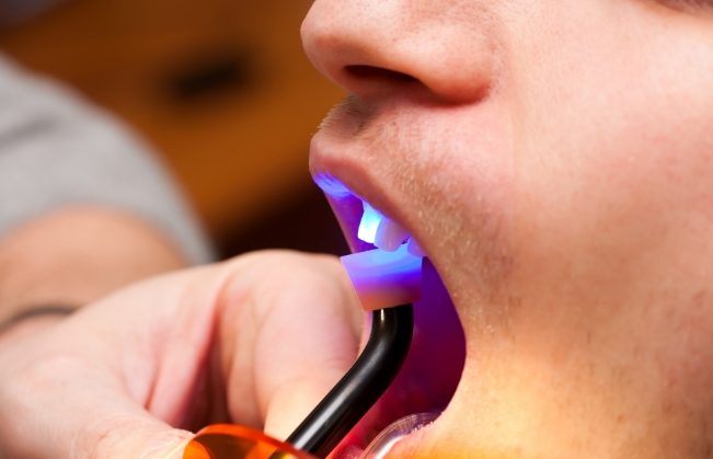 Close up of patient getting cosmetic dental bonding