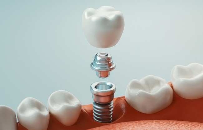 Animated dental implant with dental crown