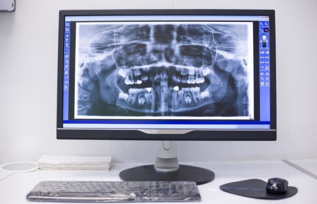 Computer screen showing digital dental x rays