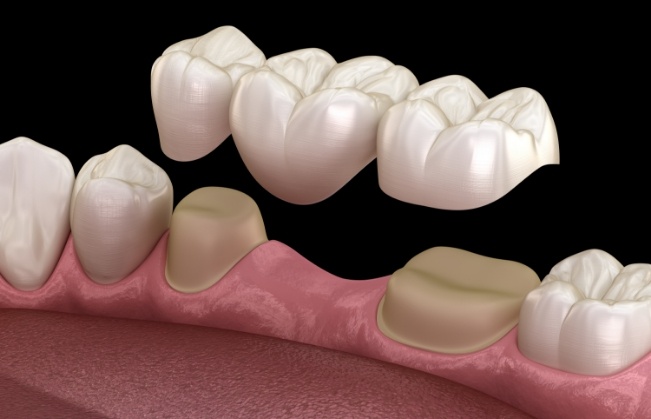 Animated dental bridge replacing a missing tooth