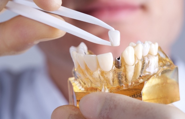 Dentist placing a dental crown atop a model of a dental implant