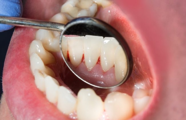 Close up of dental mirror inside of mouth