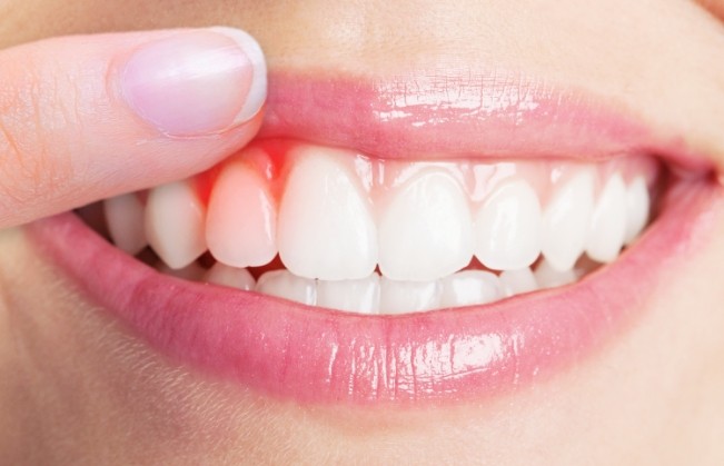 Close up of person pointing to red area of their gums