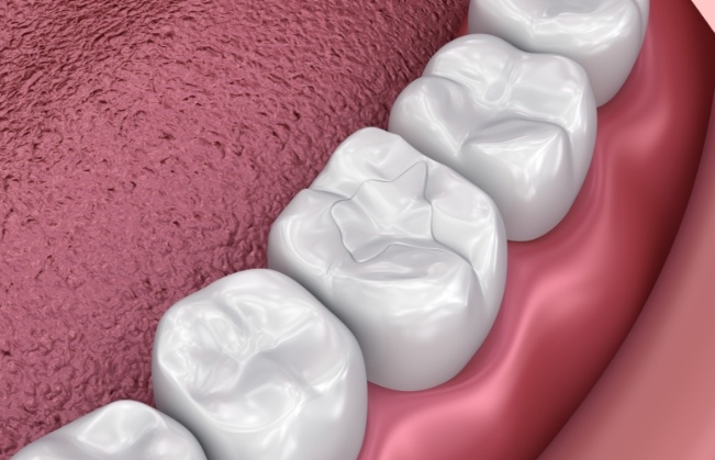 Animated row of teeth with dental sealants