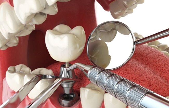 How dental implants work in Covington 