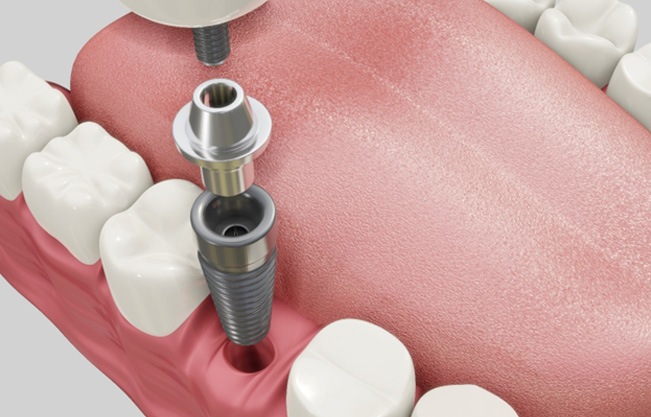 CUp-close view of dental implant parts 