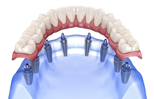 A digital image of an implant denture 