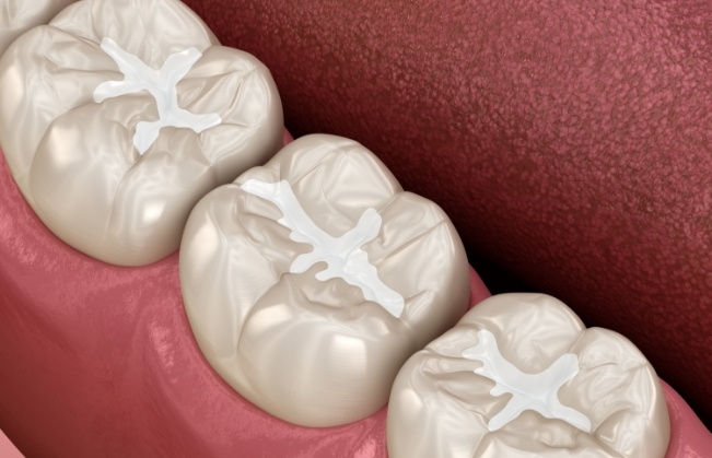 Animated row of teeth with tooth colored fillings