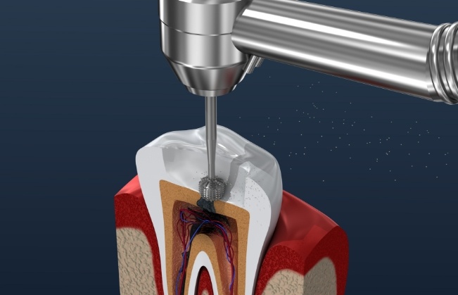 Animated model of tooth receiving root canal treatment