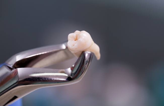 Dental forceps holding an extracted tooth