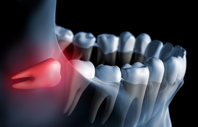 Animated x ray of impacted wisdom tooth